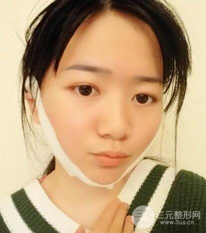 怎樣減掉雙下巴？雙下巴吸脂后個人經(jīng)歷 價格略貴但果好