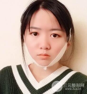怎樣減掉雙下巴？雙下巴吸脂后個人經(jīng)歷 價格略貴但果好