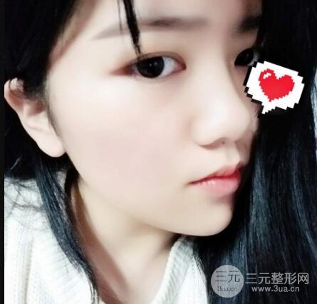 怎樣減掉雙下巴？雙下巴吸脂后個人經(jīng)歷 價格略貴但果好