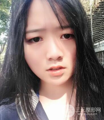 怎樣減掉雙下巴？雙下巴吸脂后個人經(jīng)歷 價格略貴但果好