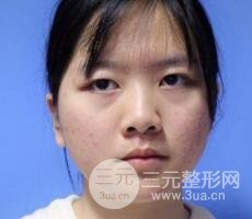 怎樣減掉雙下巴？雙下巴吸脂后個人經(jīng)歷 價格略貴但果好