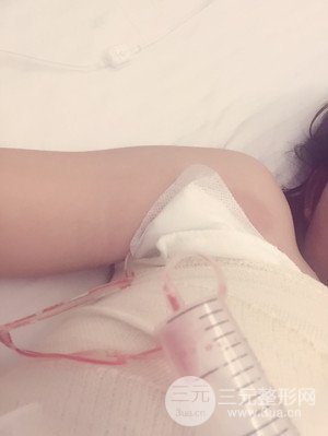 珠海萊茵門診部盧剛醫(yī)生假體隆胸真實案例，還有前后對比照片喲