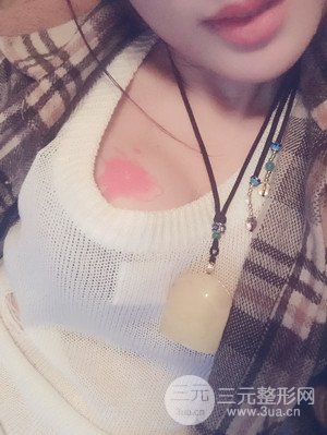 珠海萊茵門診部盧剛醫(yī)生假體隆胸真實案例，還有前后對比照片喲