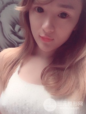 珠海萊茵門診部盧剛醫(yī)生假體隆胸真實案例，還有前后對比照片喲