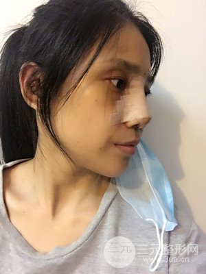 珠海萊茵門診部馬中衛(wèi)隆鼻整形案例分享，并附上前后對比照片~