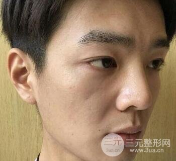 高強度聚焦超聲面b提升術(shù)多少錢?親身經(jīng)歷案例
