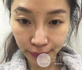 面部抗衰術(shù)多少錢?價格和案例分享