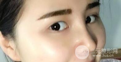 鼻子整形恢復過程真人案例