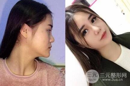 鼻子整形恢復過程真人案例