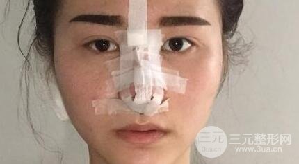 鼻子整形恢復過程真人案例