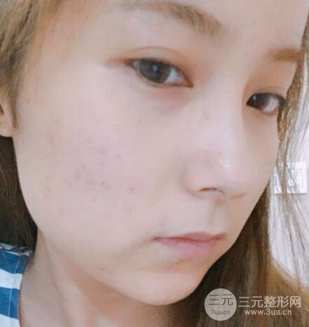 注射水光補水價格和案例圖片