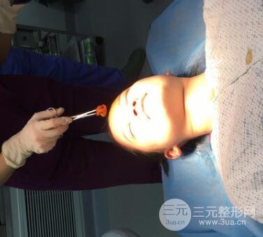三點定位雙眼皮整形恢復圖案例