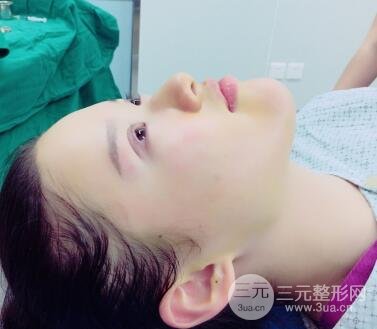 三點定位雙眼皮整形恢復圖案例