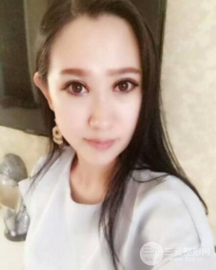雙眼皮修復(fù)術(shù)價(jià)錢和案例圖