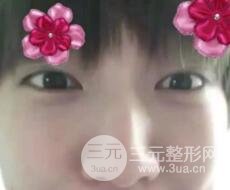 微創(chuàng)內(nèi)切去眼袋手術(shù)價(jià)格和恢復(fù)過(guò)程圖案例