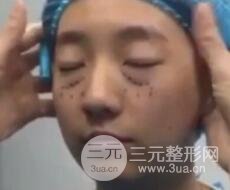 微創(chuàng)內(nèi)切去眼袋手術(shù)價格和恢復(fù)過程圖案例