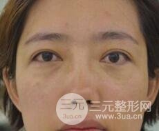 超聲法去眼袋價格和前后圖片案例