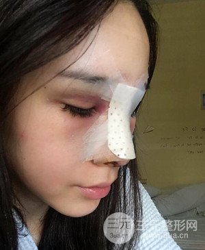 武漢美都張召醫(yī)生給我做的隆鼻整形手術(shù)，給大家分享一下前后照片