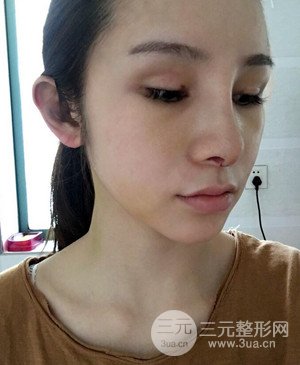 武漢美都張召醫(yī)生給我做的隆鼻整形手術(shù)，給大家分享一下前后照片