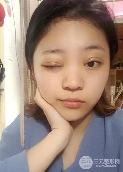 切開雙眼皮手術(shù)恢復(fù)過程圖案例