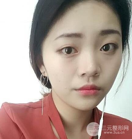 切開雙眼皮手術(shù)恢復(fù)過程圖案例