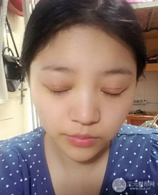 切開雙眼皮手術(shù)恢復(fù)過程圖案例