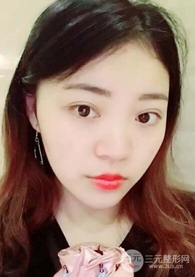 切開雙眼皮手術(shù)恢復(fù)過程圖案例