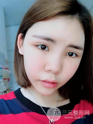 自體脂肪填充全臉真實案例——濟(jì)南愛容張慶國醫(yī)生做的