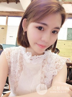 自體脂肪填充全臉真實案例——濟(jì)南愛容張慶國醫(yī)生做的