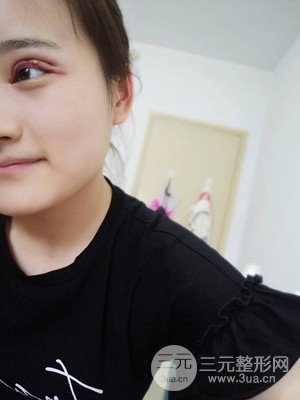 雙眼皮多項整形整形案例以及前后對比圖分享——濟(jì)南愛容路傳燕醫(yī)生做的~