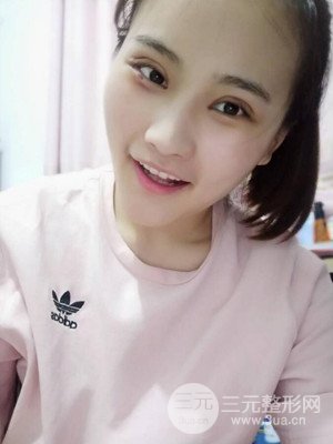 雙眼皮多項整形整形案例以及前后對比圖分享——濟(jì)南愛容路傳燕醫(yī)生做的~