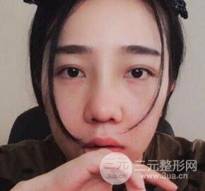 隆鼻整形價格和真人案例