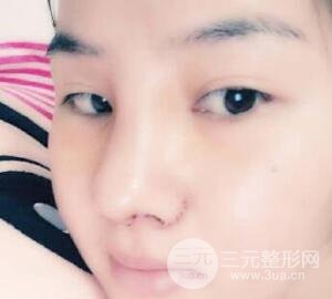 蒜頭鼻整形價格和對比照片案例