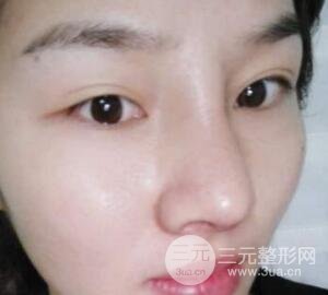 蒜頭鼻整形價格和對比照片案例