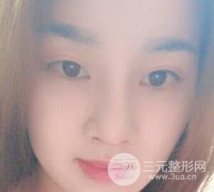 蒜頭鼻整形價格和對比照片案例