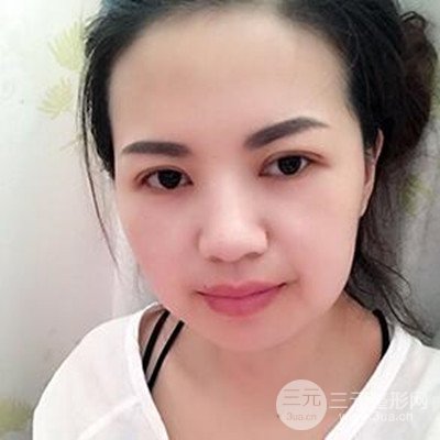 濟(jì)南海峽謝燕燕做的雙眼皮多項(xiàng)整形整形手術(shù)，分享一下前后對(duì)比圖