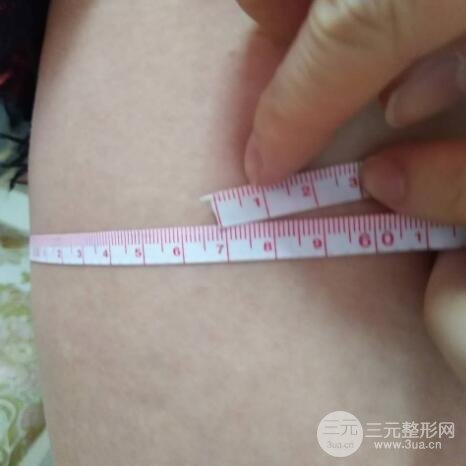 大腿環(huán)吸抽脂價(jià)格和圖片案例