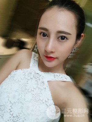 隆鼻失敗修復(fù)手術(shù)真實案例以及前后對比圖——青?？等A馮相周醫(yī)生做的