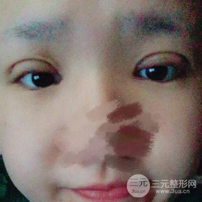 汕頭愛(ài)麗諾蘇國(guó)藝給我做的雙眼皮手術(shù)，把前后的對(duì)比圖片分享給大家