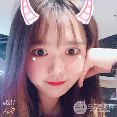 汕頭愛(ài)麗諾蘇國(guó)藝給我做的雙眼皮手術(shù)，把前后的對(duì)比圖片分享給大家