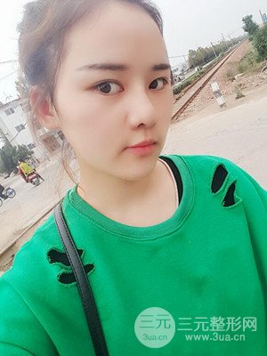 硅膠假體墊下巴真實(shí)案例，汕頭愛(ài)麗諾蘇國(guó)藝做的