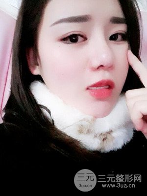 硅膠假體墊下巴真實(shí)案例，汕頭愛(ài)麗諾蘇國(guó)藝做的