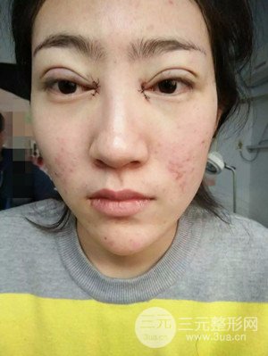 雙眼皮修復(fù)+開(kāi)內(nèi)眼角真實(shí)案例附上前后對(duì)比圖片——汕頭伊麗莎白張紅軍做的
