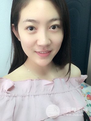 雙眼皮修復(fù)+開(kāi)內(nèi)眼角真實(shí)案例附上前后對(duì)比圖片——汕頭伊麗莎白張紅軍做的