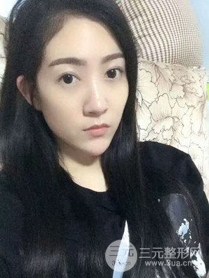 雙眼皮修復(fù)+開(kāi)內(nèi)眼角真實(shí)案例附上前后對(duì)比圖片——汕頭伊麗莎白張紅軍做的