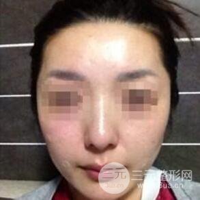 汕頭伊麗莎白張紅軍給我打的B****，分享一下前后照片