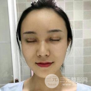 雙眼皮+開內眼角手術前后對比圖片，真實案例