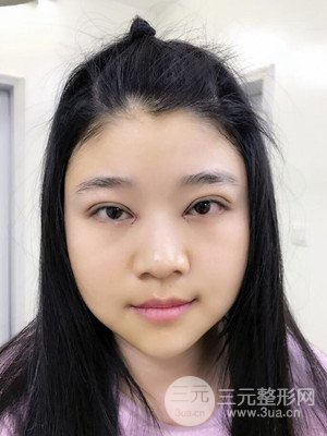 切開雙眼皮+開內(nèi)眼角真實案例，并附上前后對比圖片