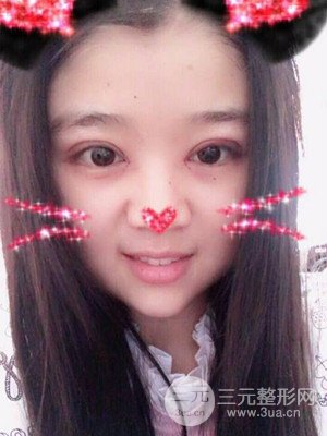 切開雙眼皮+開內(nèi)眼角真實案例，并附上前后對比圖片
