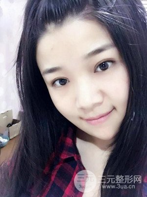 切開雙眼皮+開內(nèi)眼角真實案例，并附上前后對比圖片